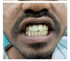 After aesthetic ceramic crown fixed at Transcend Dental Clinic Hinjawadi Pune