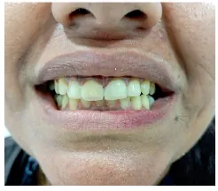 After aesthetic composite gap repair at Transcend Dental Clinic Hinjawadi Pune