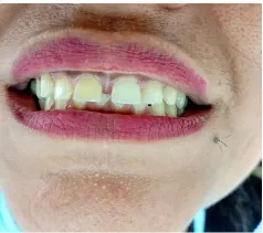 Before aesthetic composite gap repair at Transcend Dental Clinic Hinjawadi Pune