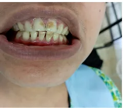 Before aesthetic front teeth repair at Transcend Dental Clinic Hinjawadi Pune