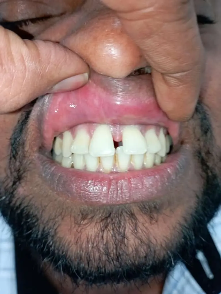 Before dental smile correction treatment at Transcend Dental Clinic Hinjawadi Pune