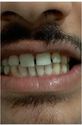 After broken tooth repair by composite at Transcend Dental Clinic Hinjawadi Pune
