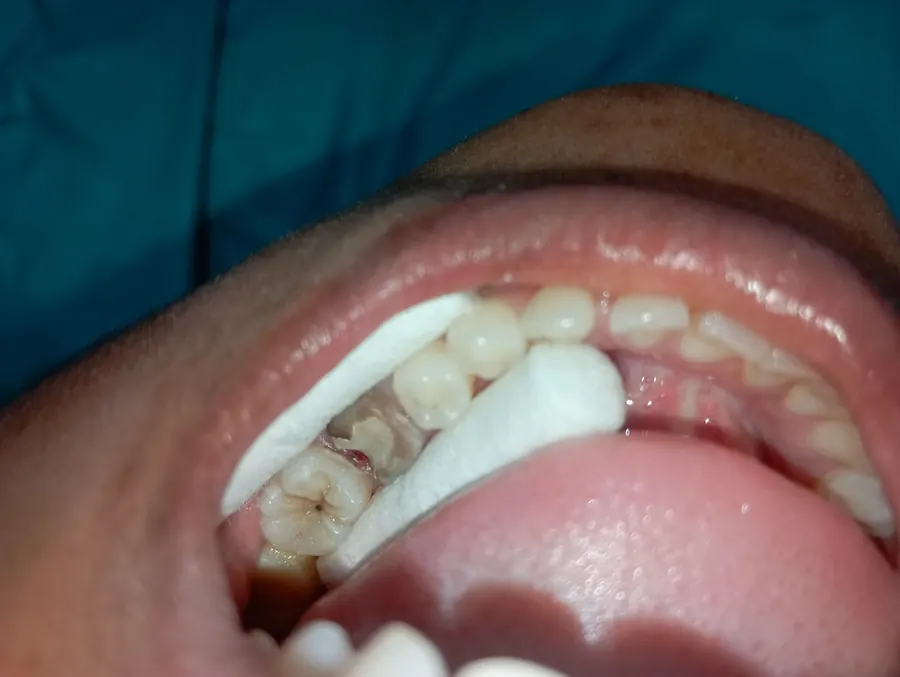 Before ceramic cap after root canal treatment at Transcend Dental Clinic Hinjawadi Pune