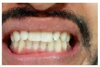 After composite teeth repair at Transcend Dental Clinic Hinjawadi Pune