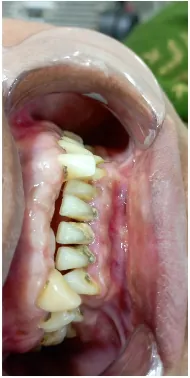Before zirconia crowns and bridges treatment to fill teeth gaps at Transcend Dental Clinic Hinjawadi Pune